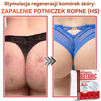 🔥🔥  GFOUK® Plastry do usuwania brodawek i znamion z mikronakłuciami roślinnymi