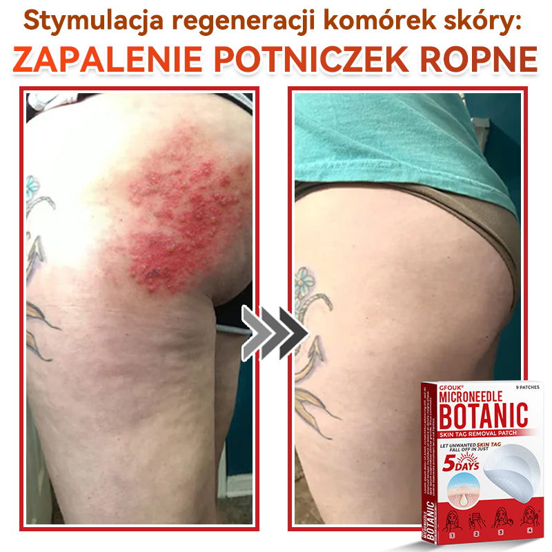 🔥🔥  GFOUK® Plastry do usuwania brodawek i znamion z mikronakłuciami roślinnymi