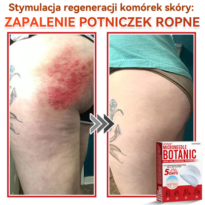 🔥🔥  GFOUK® Plastry do usuwania brodawek i znamion z mikronakłuciami roślinnymi