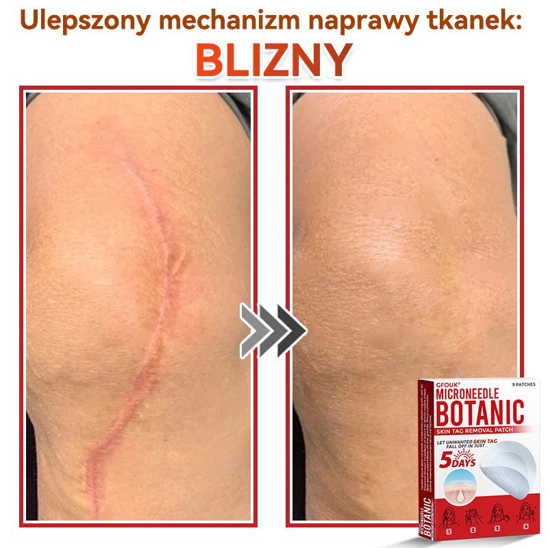 🔥🔥  GFOUK® Plastry do usuwania brodawek i znamion z mikronakłuciami roślinnymi