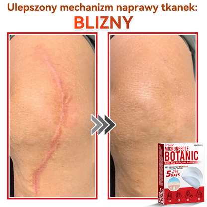 🔥🔥  GFOUK® Plastry do usuwania brodawek i znamion z mikronakłuciami roślinnymi