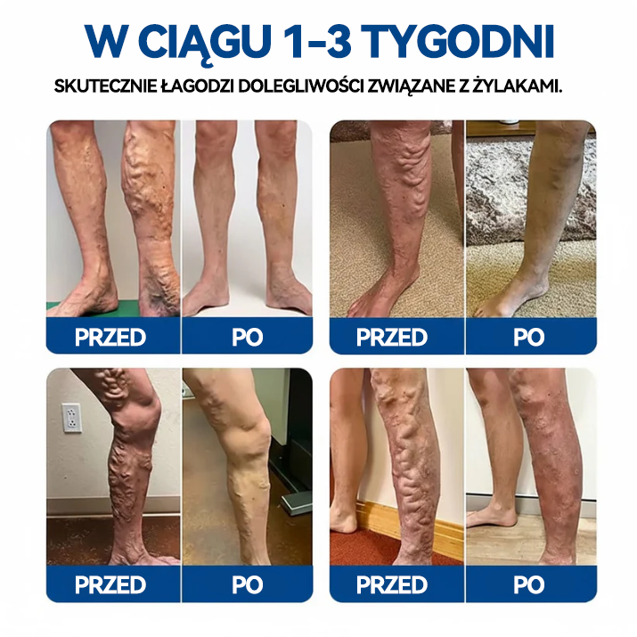 🎖️🇵🇱👨‍⚕️✅TAILEDEN® VeinEase Plastry z Mikronakłuciami⚡Natychmiastowa ulga, długotrwałe rezultaty.z