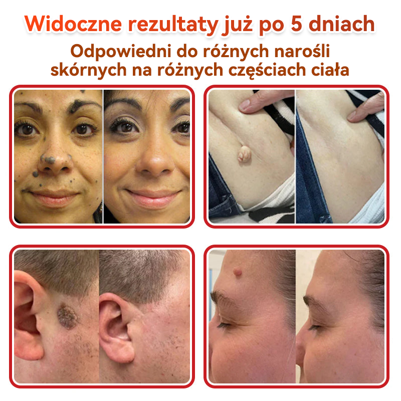 🔥🔥  GFOUK® Plastry do usuwania brodawek i znamion z mikronakłuciami roślinnymi