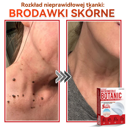 🔥🔥  GFOUK® Plastry do usuwania brodawek i znamion z mikronakłuciami roślinnymi