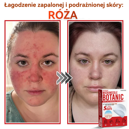 🔥🔥  GFOUK® Plastry do usuwania brodawek i znamion z mikronakłuciami roślinnymi