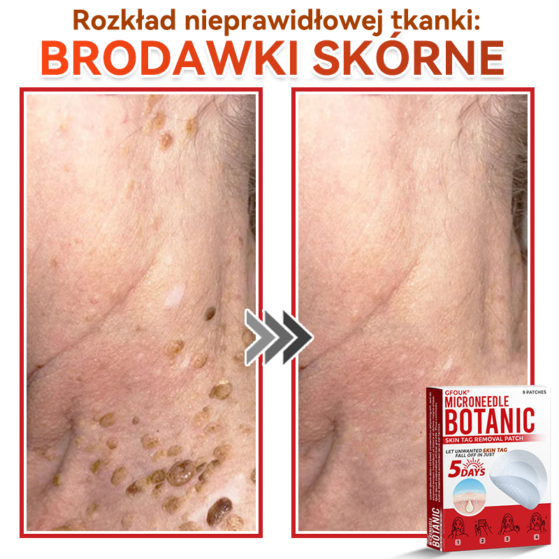 🔥🔥  GFOUK® Plastry do usuwania brodawek i znamion z mikronakłuciami roślinnymi