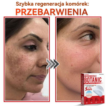 🔥🔥  GFOUK® Plastry do usuwania brodawek i znamion z mikronakłuciami roślinnymi