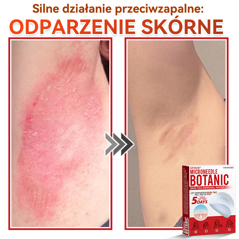 🔥🔥  GFOUK® Plastry do usuwania brodawek i znamion z mikronakłuciami roślinnymi